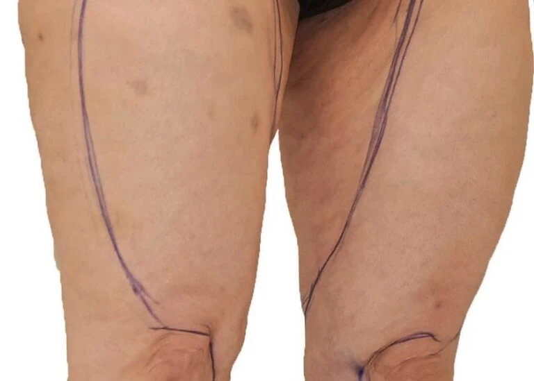 Legs marked before lipedema liposuction