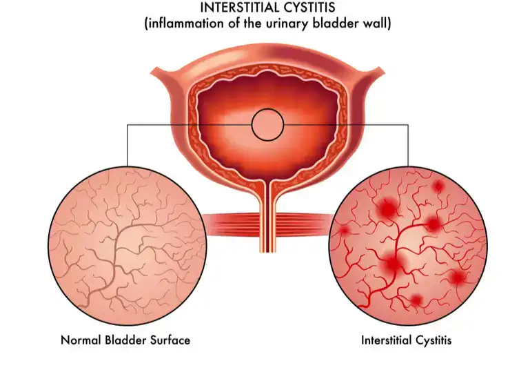 Macroarea Cistite femminile