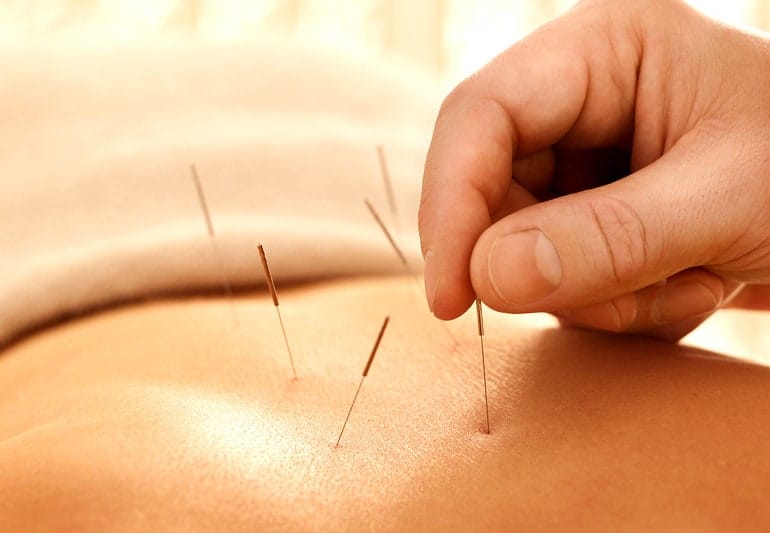 Acupuntura para o tratamento da neuropatia periférica: uma revisão sistemática e meta-análise 2 Acupuntura8