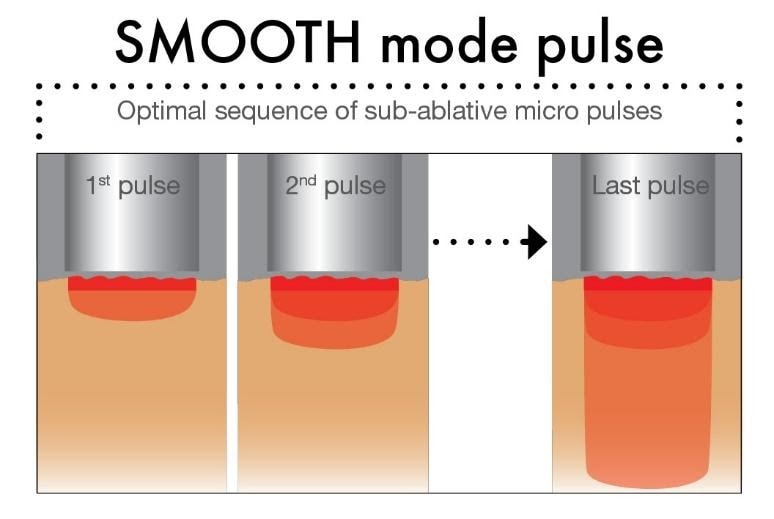 Fotona Smooth mode for eye bags