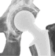 X-ray of total hip replacement prosthesis after surgery