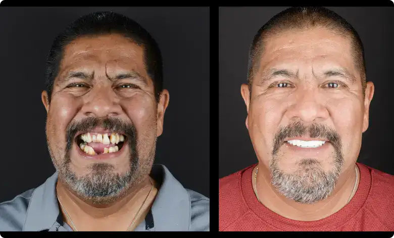 dental implants austin