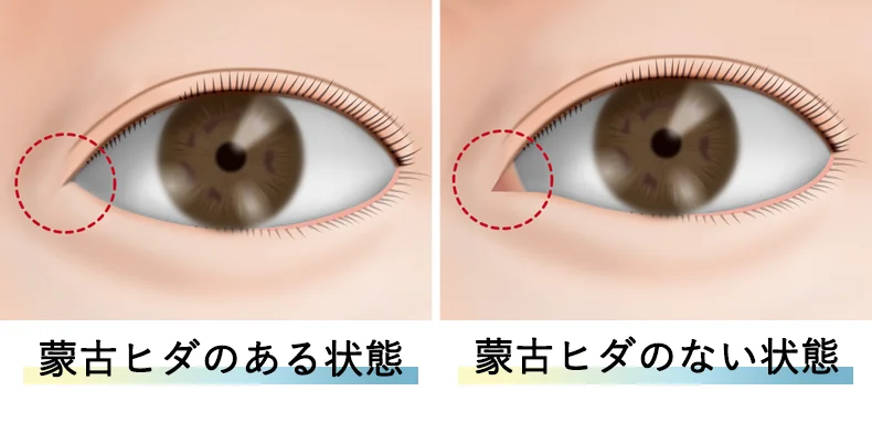 目頭切開
