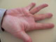 Dupuytren's contracture hand deformity