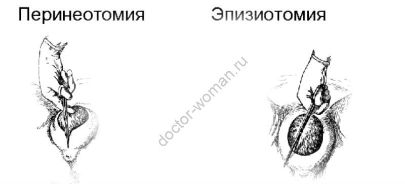 Эпизиотомия и перинеотомия