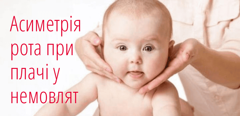 Асиметрія рота при плачі у немовлят