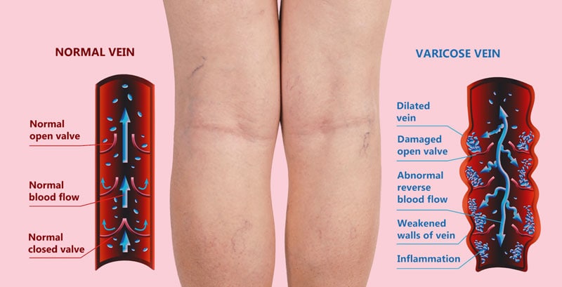 Varicose Vein Treatment New Haven CT Varicose Vein Treatment New Haven CT