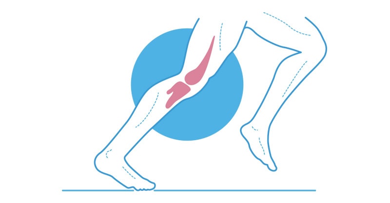 Síndrome de la cintilla Iliotibial