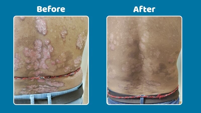 Before-and-after-treatment-for-guttate-psoriasis