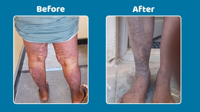 Before-and-after-treatment-for-inverse-psoriasis