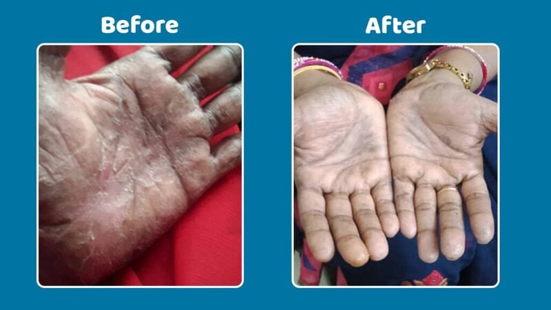 Before and after treatment for palmoplantar psoriasis