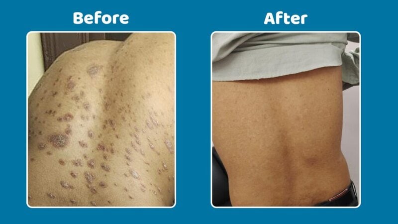 Before-and-after-treatment-for-plaque-psoriasis