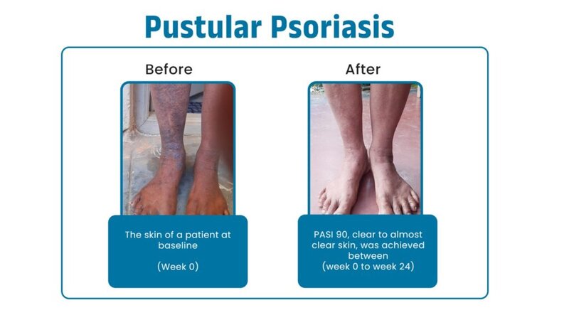 Pastular Psoriasis
