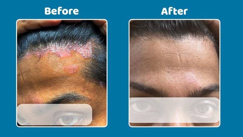scalp psoriasis treatment