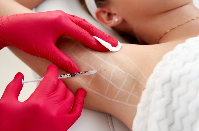 Behandling av hyperhidrose (overdreven svette) 3 - korpeveien legeklinikk injeksjonbehandling av hyperhidrose