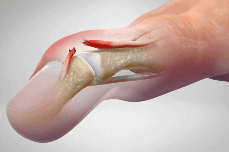 Mallet finger
