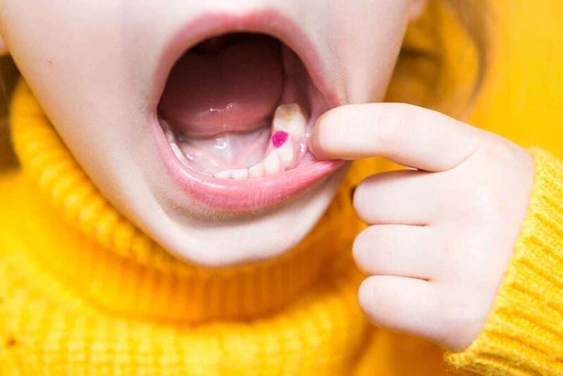What are the Available Materials for Tooth Filling? 1 tooth filling procedures