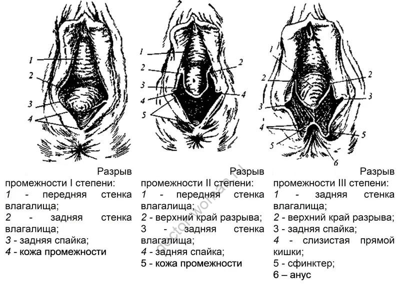 Разрывы промежности