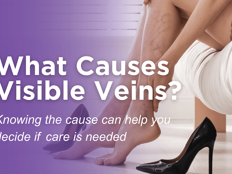 What Causes Visible Veins and When Treatment Makes Sense in Augusta, GA