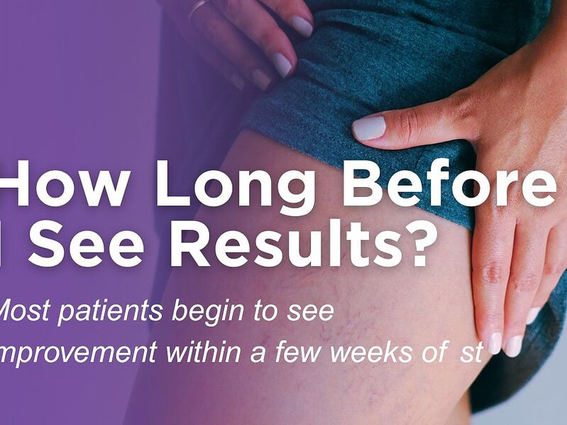 How Long After Vein Treatment Will I See Improvement?