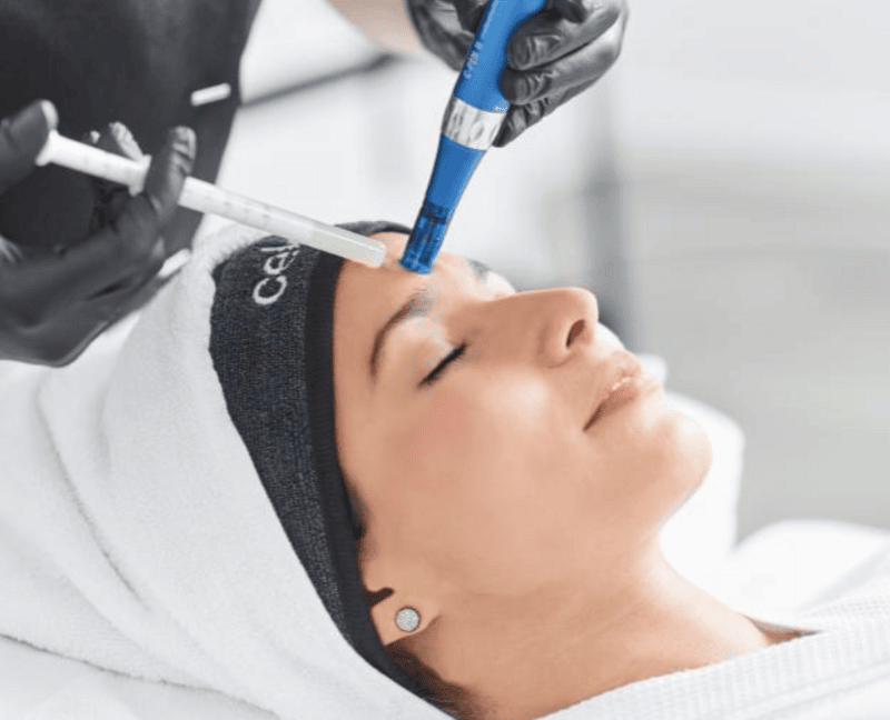 Microneedling