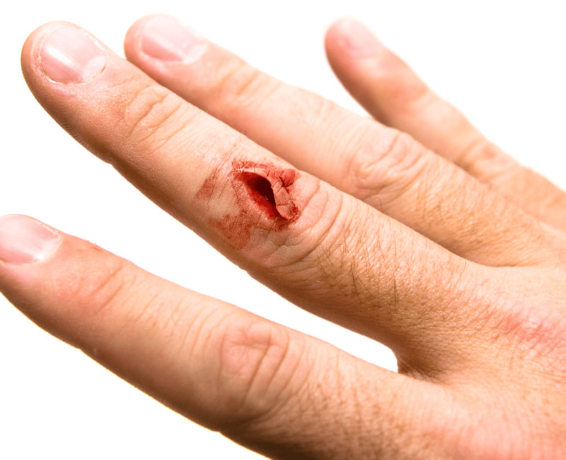 Cuts, Lacerations, and Puncture Wounds Cut Injury on Hand