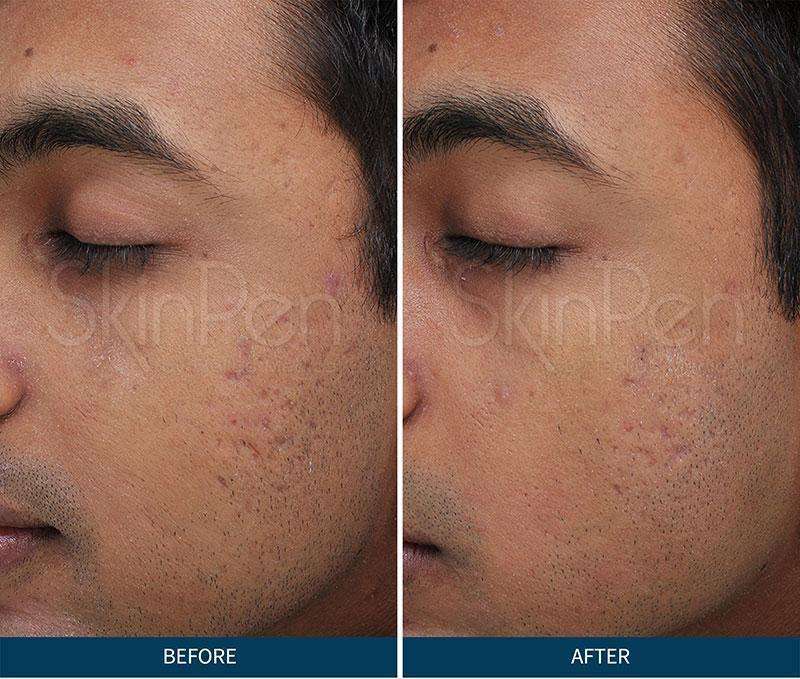 microneedling before and after