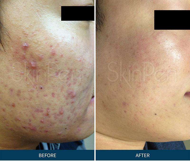 Microneedling before and after