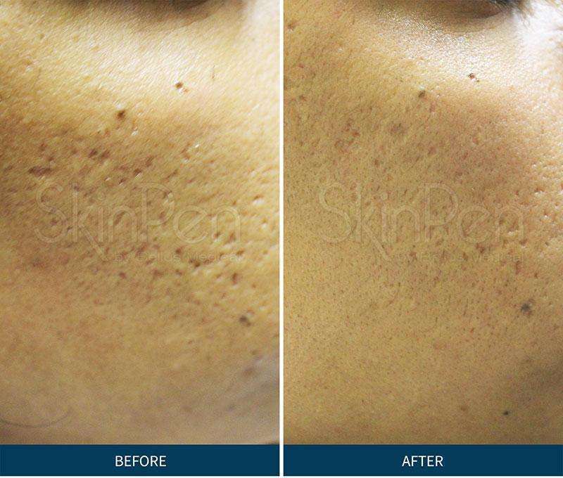 Before & After Pictures SkinPen benefits