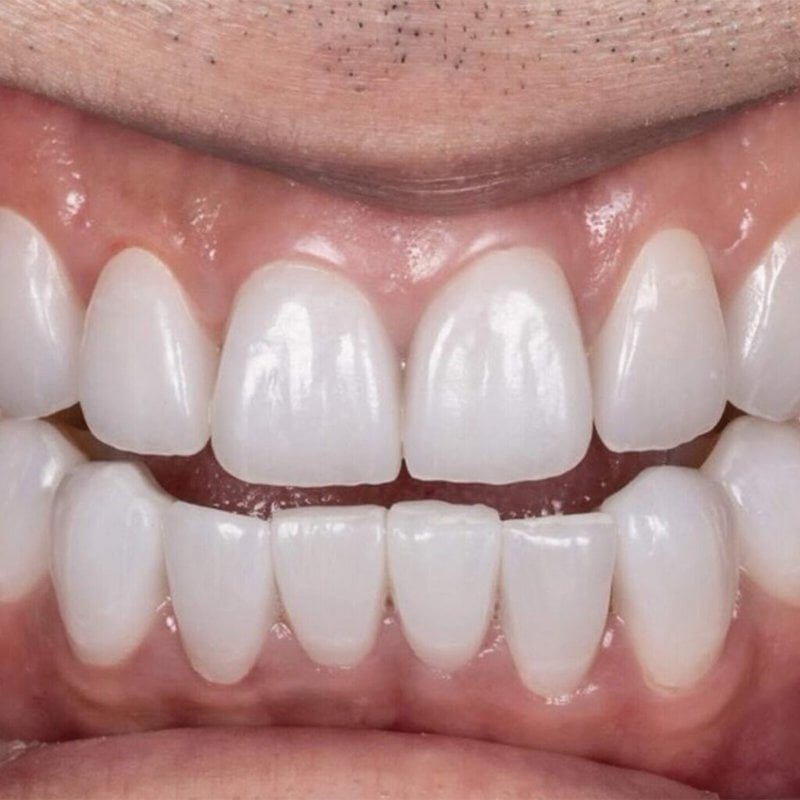 Les différents types d'appareil de prise de teinte dentaire