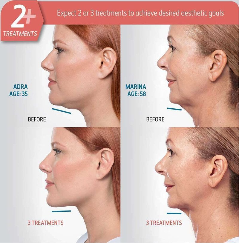 Kybella 2+ Before & After