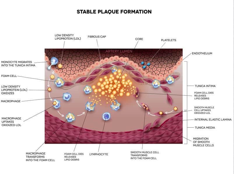 Atherosclerosis