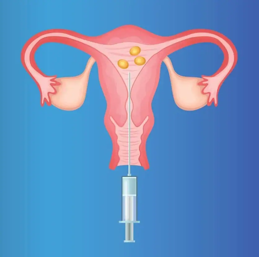 IVF Treatment
