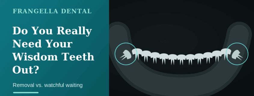 Stylized panoramic dental X-ray of the lower jaw showing both third molars mesioangularly impacted against the second molars, highlighted