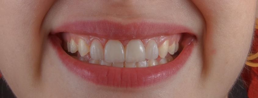 Close-up natural smile illustrating dental bonding versus porcelain veneers