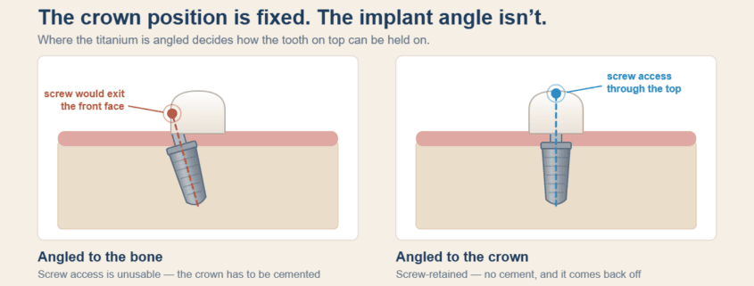 Diagram comparing two implants under identical crowns: one angled to the bone, whose screw channel exits the front face of the crown, and one angled to the crown, whose screw access exits through the biting surface.