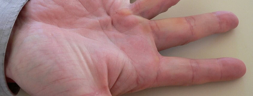Dupuytren's contracture hand deformity