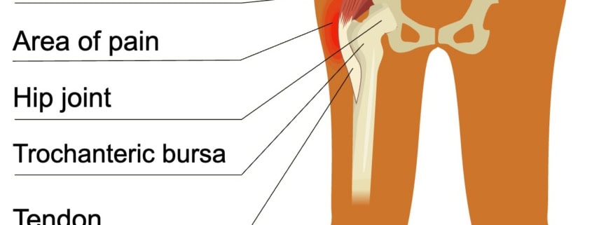 Hip bursitis diagram showing trochanteric bursa and area of pain