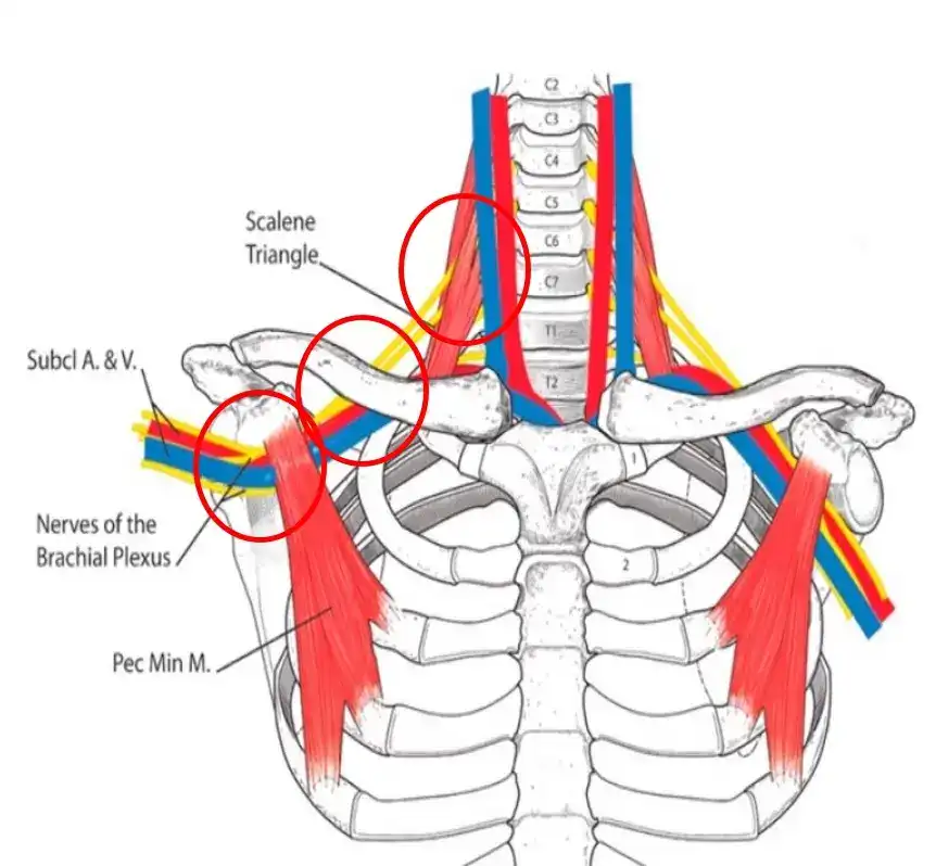 Thoracic Outlet Syndrome is treated at Prairie Osteopath Medical Clinic in Regina SK