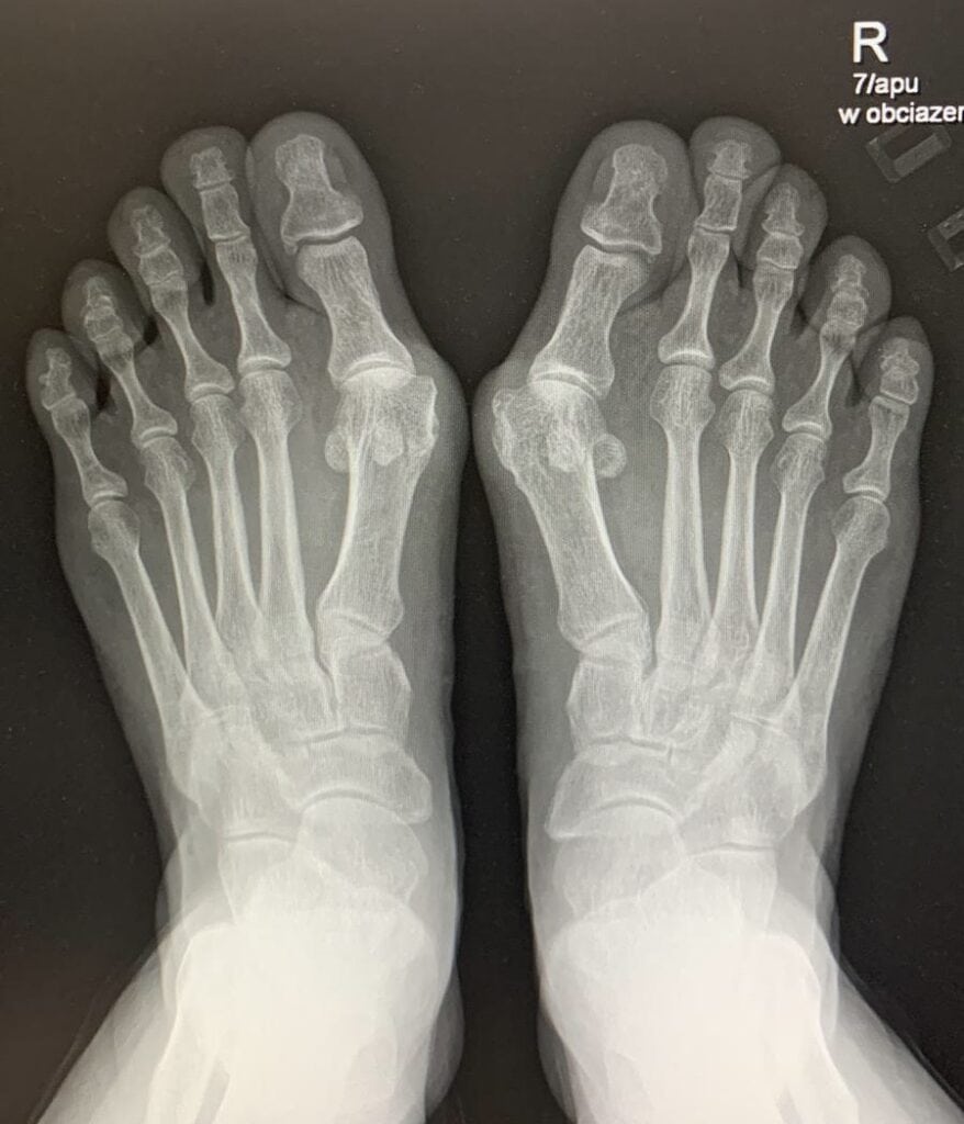 Konsultacja ortopedyczna stopy