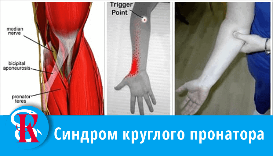 Синдром круглого пронатора