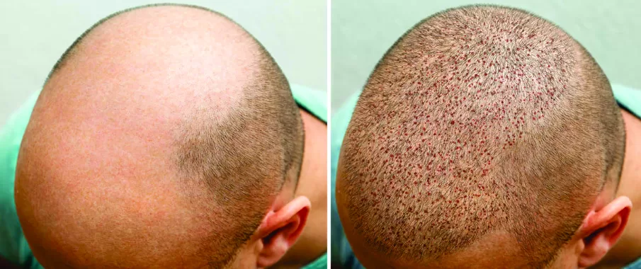 Implante Cabelo Goiânia