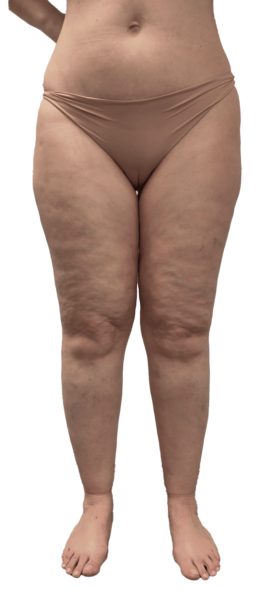 Fotografía clínica de lipedema en piernas — Unidad de Lipedema Clínica Fontana Valencia