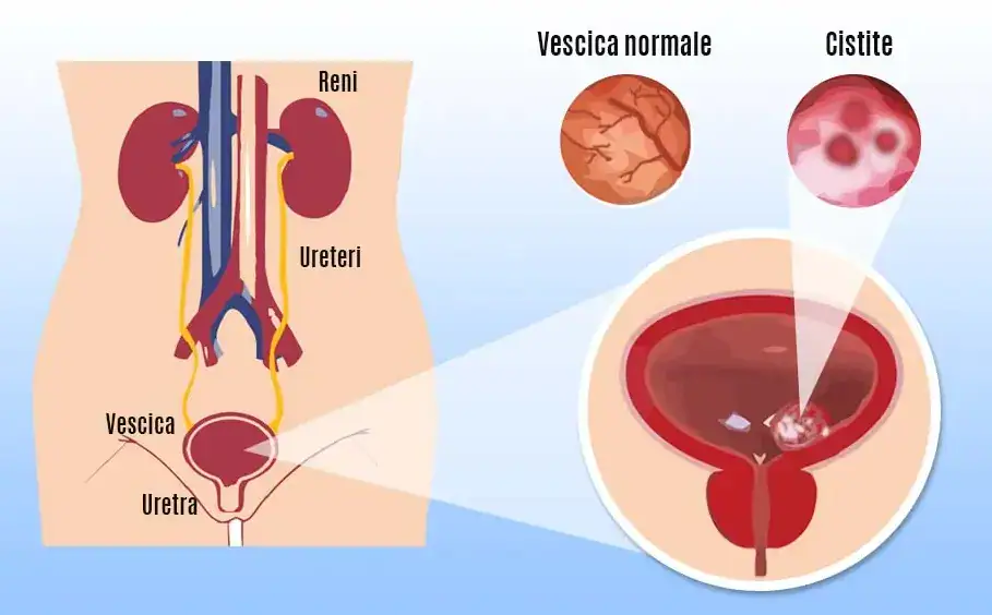 Macroarea Cistite femminile