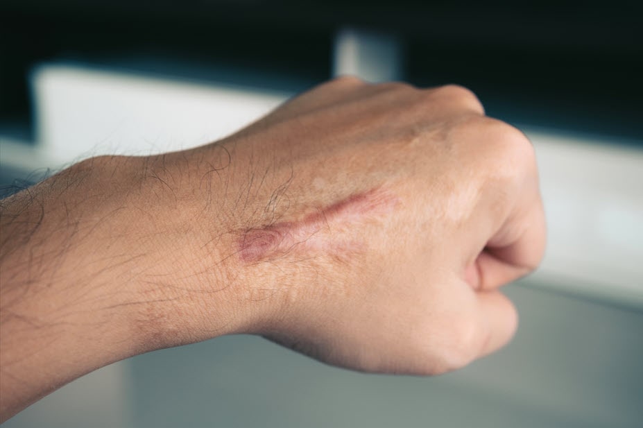 Schmidt Dog Bites that Result in Scarring Are Serious Personal Injury Cases