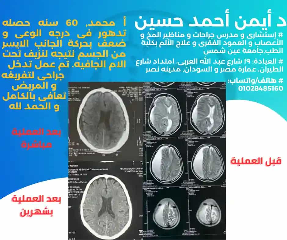 تفريغ نزيف مزمن تحت الأم الجافيه