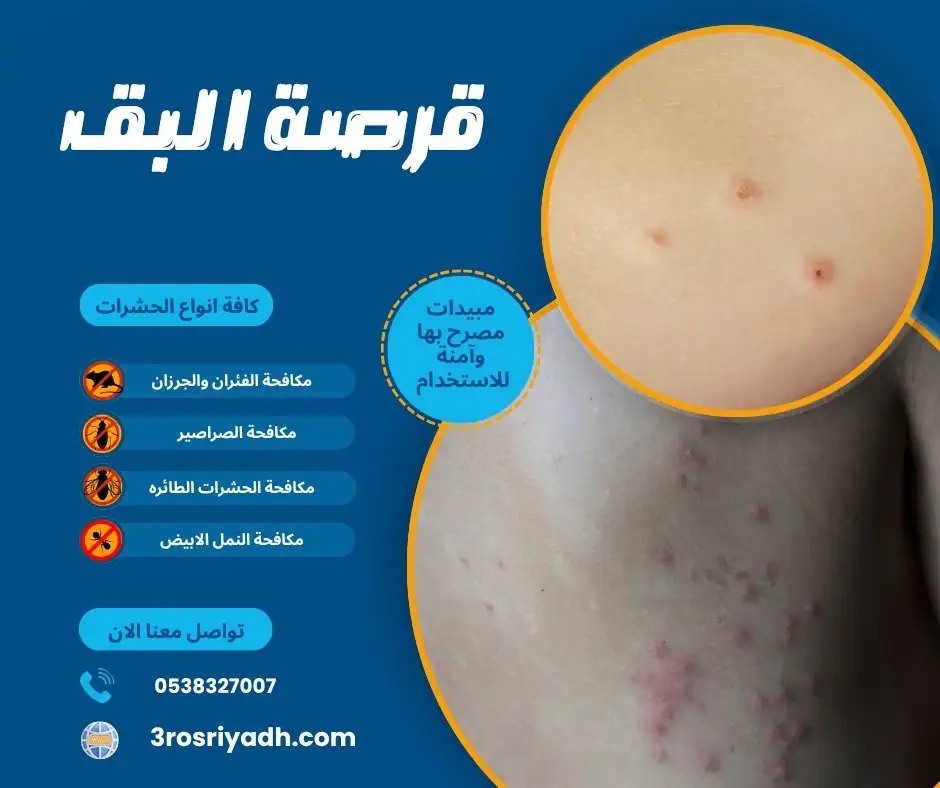 قرصة البق
