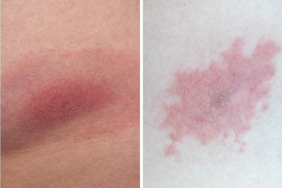 prevent tick bites when hiking otherwise a rash is the least of your concerns