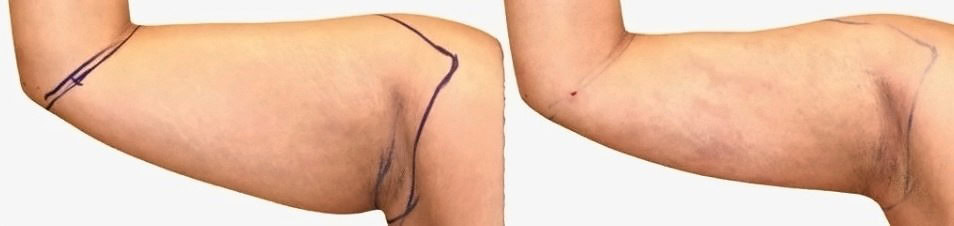 Arm liposuction before and after, actual patient of Dr. Long