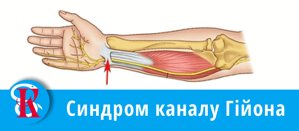 Синдром каналу Гійона